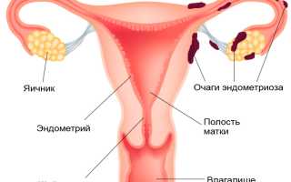 Как лечат эндометриоз у женщин после 40 лет? Полезные советы и рекомендации