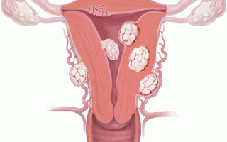 Как вылечить миому народными средствами эффективно и безопасно