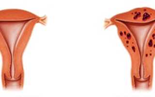 Как проявляется внутренний эндометриоз матки у женщин: симптомы и лечение