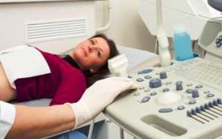 Как лечить узловую форму аденомиоза матки? Полезные советы и рекомендации