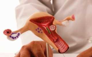 Можно ли делать ЭКО при эндометриозе? Важные аспекты и рекомендации