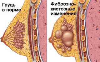 Почему может болеть грудь перед месячными и что делать для облегчения?