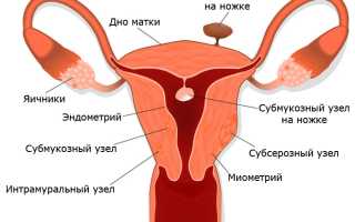 Почему развивается фиброматозный узел матки и чем он опасен для здоровья?