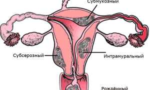 Может ли миома матки перерасти в рак? Важные аспекты здоровья