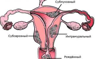 Может ли миома матки перерасти в рак? Важные аспекты здоровья