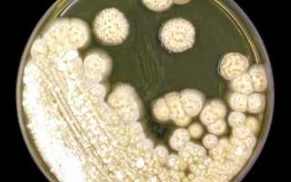 Какие анализы выявляют молочницу и ее причины?