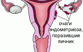 Как выявить эндометриоз яичников и чем лечить? Полезные советы и рекомендации