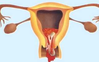 2 причины, почему после задержки пошли обильные месячные у женщин