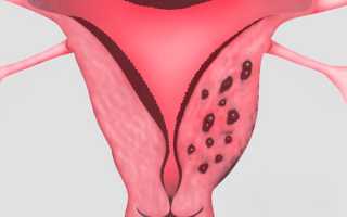 Как лечить аденомиоз матки народными средствами в домашних условиях