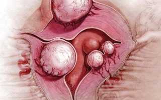 Может ли миома матки появиться при климаксе и как это предотвратить?