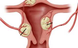 Что представляет собой фибромиома матки? Узнайте важные детали