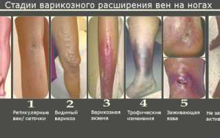 Что лечит врач флеболог и когда нужно обращаться к нему?