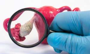 Когда должны пойти месячные после лапароскопии? Важные аспекты восстановления