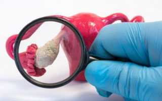 Когда должны пойти месячные после лапароскопии? Важные аспекты восстановления