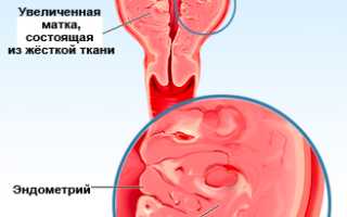 Как забеременеть и сохранить беременность при аденомиозе? Полезные советы и рекомендации