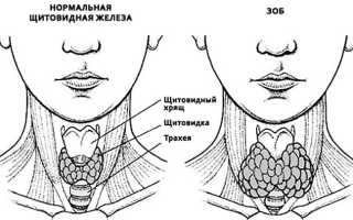 Что такое эутиреоз щитовидной железы, симптомы и лечение