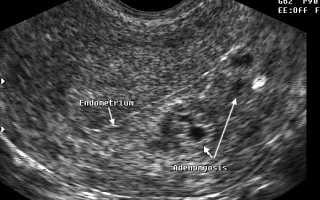 Аденомиоз матки: в каких случаях нужна операция и как ее проводят?