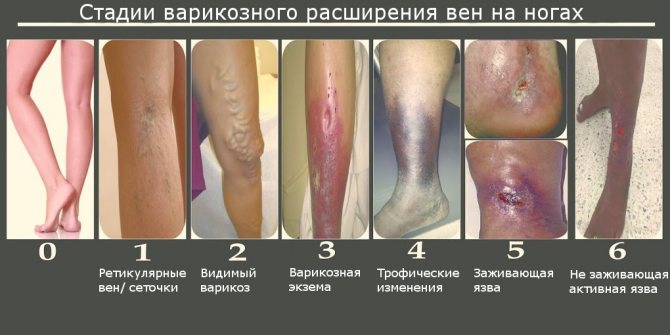 Стадии варикоза фото