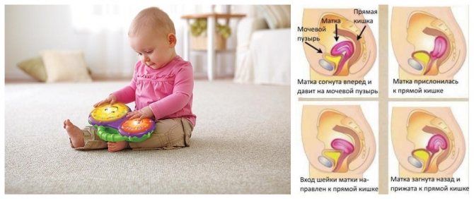 Загиб шейки матки у детей