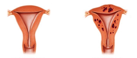 Матка здоровая и с внутренним эндометриозом