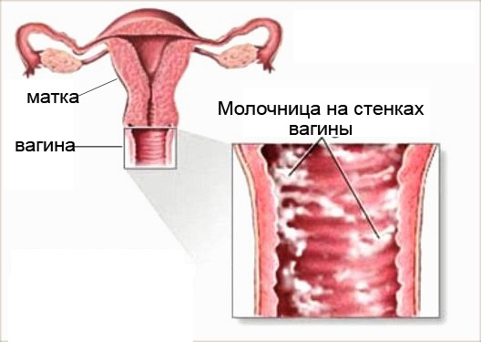 как выглядит молочница