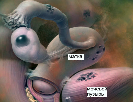 эндометриоз фото внутренних органов