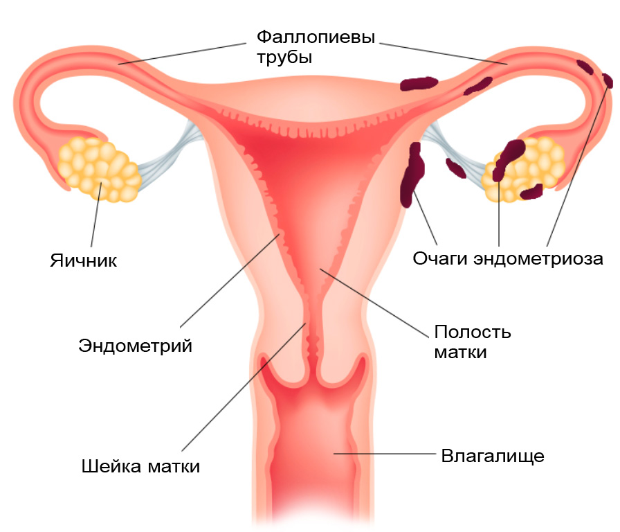 фото эндометриоз