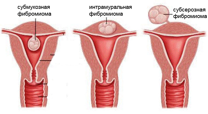 фибромиомы фото