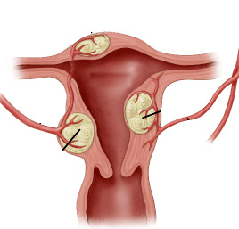 диагноз фибромиома в матке опасен
