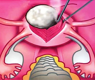 миомэктомия схема
