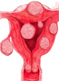 фибромиома рисунок