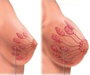 отекшая грудь