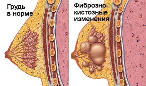 фиброзные изменения и норма