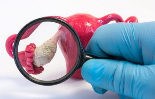 Киста яичника