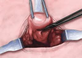 может ли миома перерасти в раковую опухоль