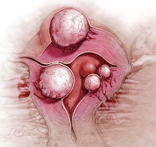 женщина у врача гинеколога по поводу миомы климакса
