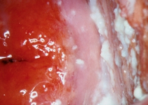 влагалищная молочница