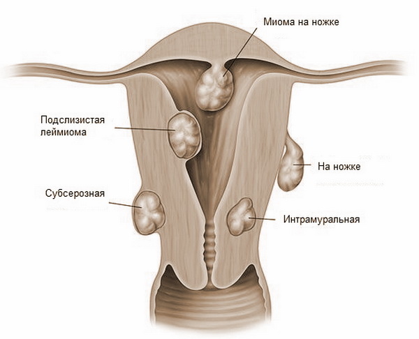 Опухоль в матке