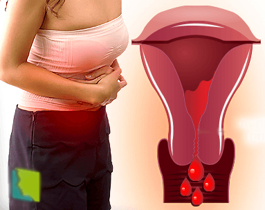 как остановить сильное кровотечение при месячных