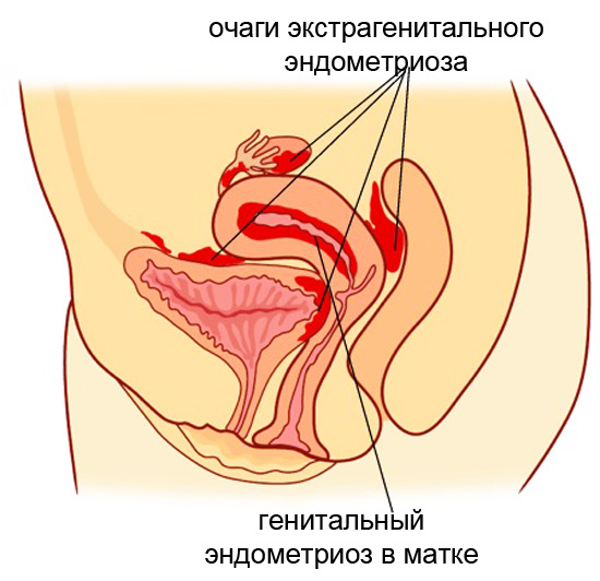 очаги эндометриоза схема