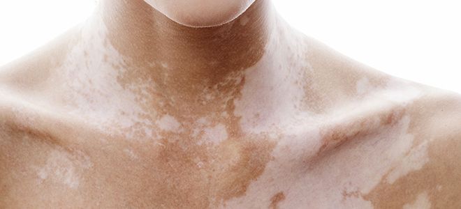 белые пятна на теле белые пятна на теле