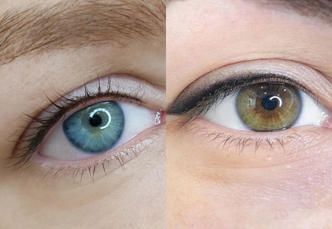 межресничка для нависшего века межресничка для нависшего века