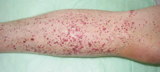 темные пятна на коже темные пятна на коже