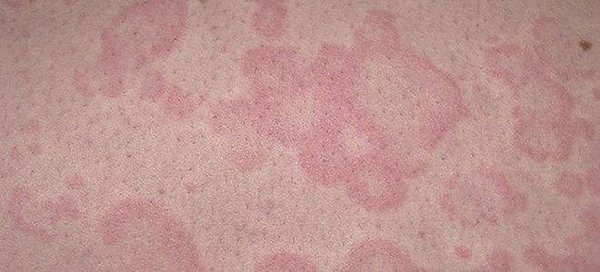 аллергия на коже красные пятна аллергия на коже красные пятна
