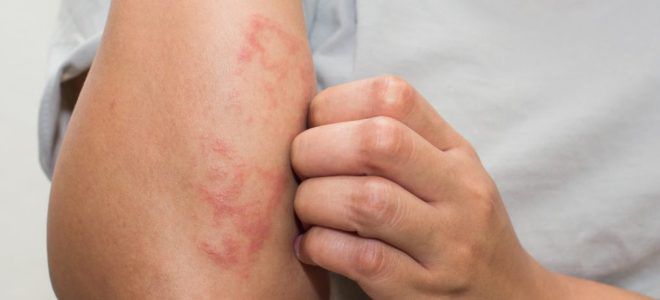 Аллергия на яблоки симптомы Аллергия на яблоки симптомы