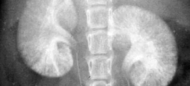 аплазия почки что это аплазия почки что это