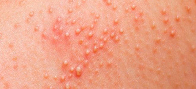 буллезный дерматит причины буллезный дерматит причины