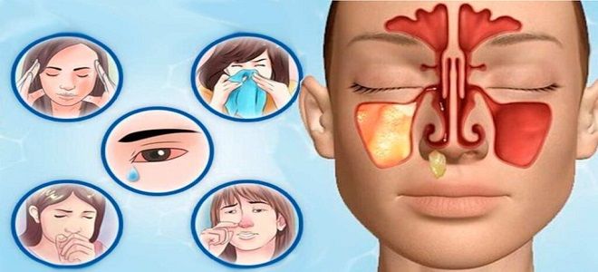 частые синуситы у взрослого частые синуситы у взрослого