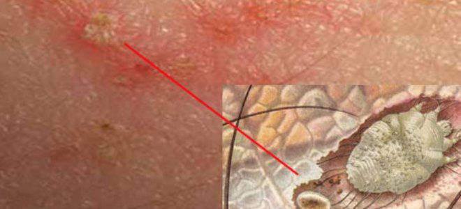 чесотка причины возникновения чесотка причины возникновения