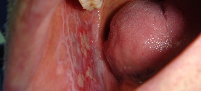 что такое красныи плоскии лишаи что такое красныи плоскии лишаи